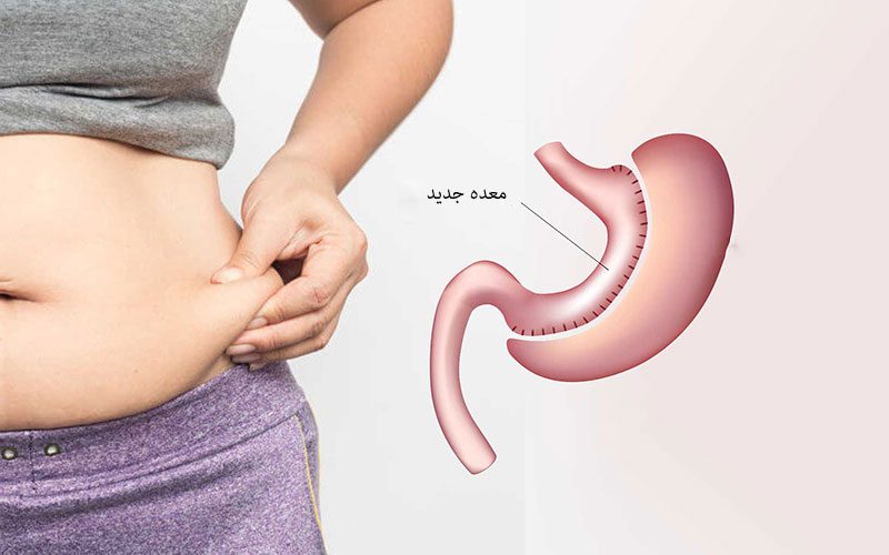 Gastric sleeve service