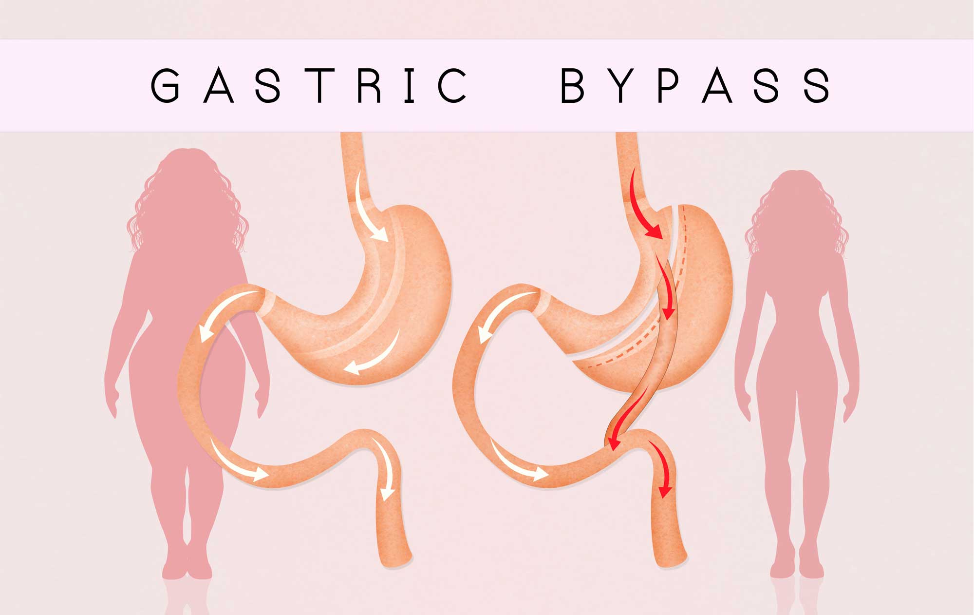 Gastric sleeve service